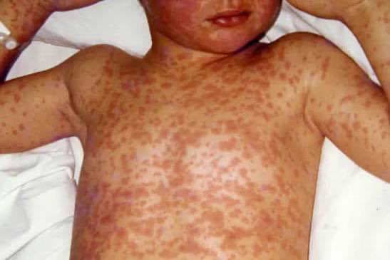 Bangladesh measles crisis deepens as child deaths climb amid vaccination gaps
